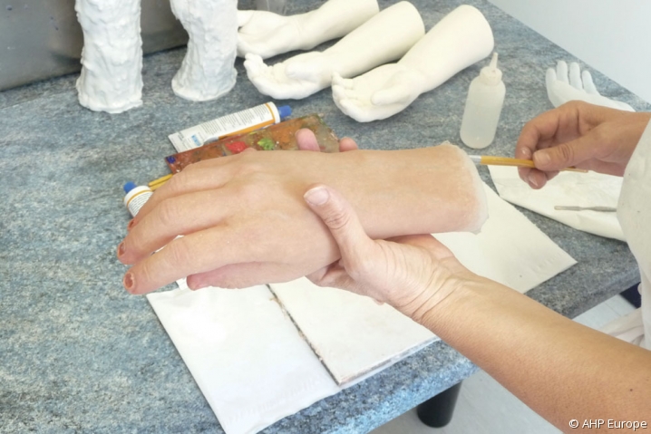 Prothèse de main et poignet réalisée dans l'atelier du prothésiste AHP Europe, basé à Maisons-Alfort